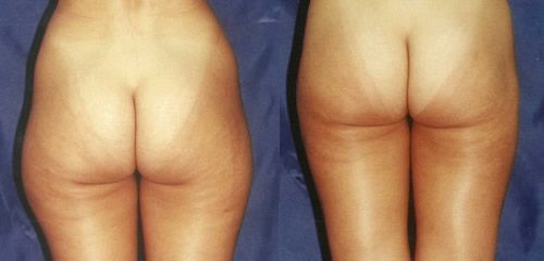 Liposucción glúteos