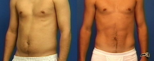 Liposucción hombres