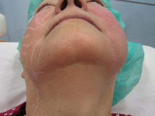 Rejuvenecimiento Facial Dr. Beltrán
