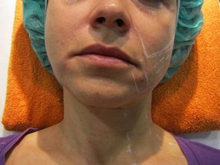 Rejuvenecimiento Facial Dr. Beltrán