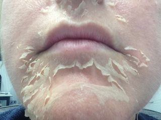 Peeling Quimico Rejuvenecimiento Facial