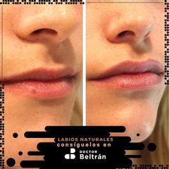 Aumento de labios - Doctor Beltrán