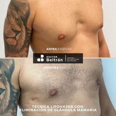 Ginecomastia - Doctor Beltrán