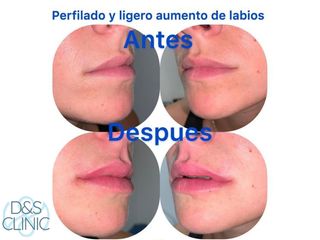 Aumento de labios - D&S Clinic