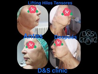 Hilos tensores - D&S Clinic