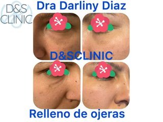 Eliminación de ojeras - D&S Clinic