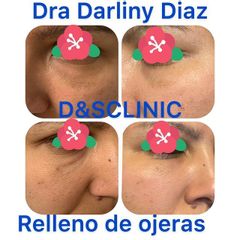 Eliminación de ojeras - D&S Clinic