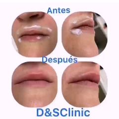 Aumento de labios - D&S Clinic