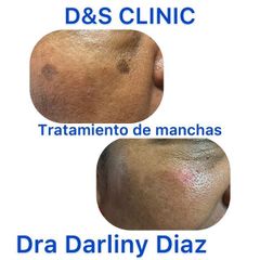 Tratamiento antimanchas - D&S Clinic