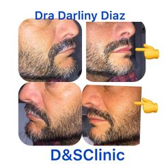 Aumento de Labios - Darliny Diaz Hernandez