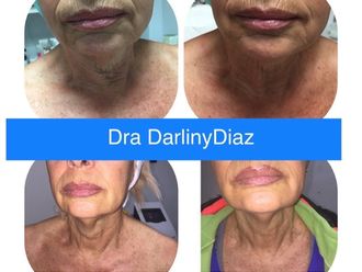 Rejuvenecimiento facial antes y después - 877245
