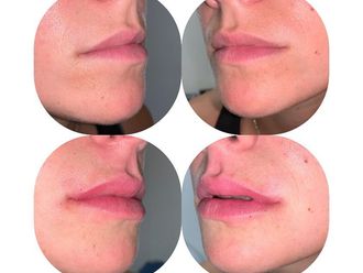 Aumento labios antes y después - 877246