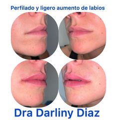 Aumento de labios - Darliny Diaz Hernandez