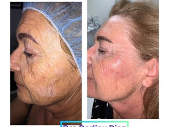 Hilos tensores antes y después - 877247