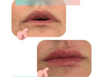 Aumento labios antes y después - 877248