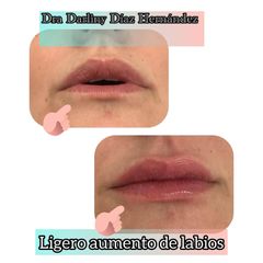 Aumento de labios - Darliny Diaz Hernandez