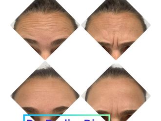 Eliminación arrugas antes y después - 877249