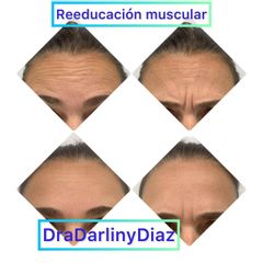 Eliminación de arrugas - Darliny Diaz Hernandez