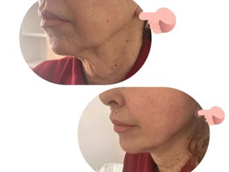 Ácido hialurónico antes y después - 877250