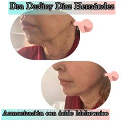 Armonización Facial - Darliny Diaz Hernandez