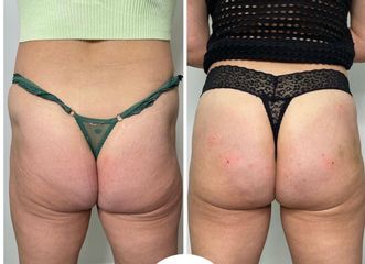 Aumento de glúteos - GAIA CLINIC SURGERY INTERNATIONAL ESTHETIC