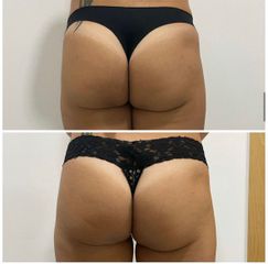 Aumento de glúteos - GAIA CLINIC SURGERY INTERNATIONAL ESTHETIC