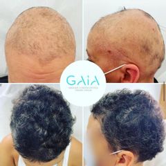 Alopecia - GAIA CLINIC SURGERY INTERNATIONAL ESTHETIC