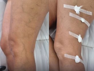 Tratamiento varices antes y después - 868188