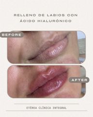 AUMENTO DE LABIOS