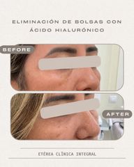 Eliminación de bolsas
