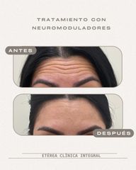 Tratamiento con neuromoduladores
