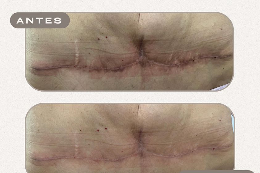 Corrección cicatrices antes y después - 881789