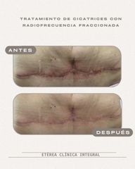 Corrección de cicatrices