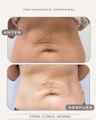 Tratamiento flacidez corporal