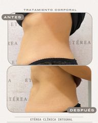 Tratamiento flacidez corporal