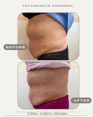 Tratamiento grasa abdominal