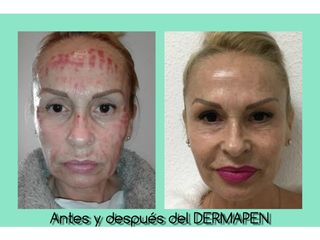 antes y despues rejuvenecimiento facial