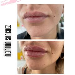 Aumento de labios - Dr. Vicente García Vegazo