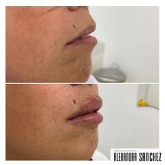Aumento de labios - Dr. Vicente García Vegazo