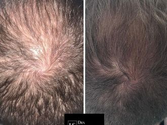 Mesoterapia capilar antes y después - 878369