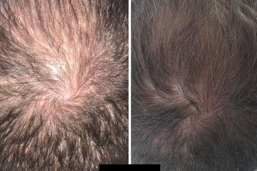 Mesoterapia capilar antes y después - 878369