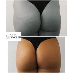 Corrección Hip Dips