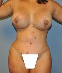 Antes y después Dermo + Mamoplastia + Lipo flancos