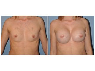 Antes y después Mamoplastia de aumento (380cc.)