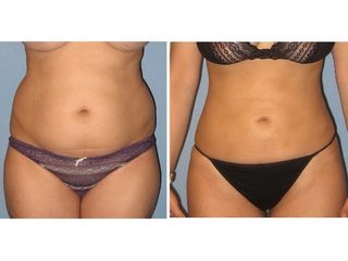 Antes y después Lipoescultura Vaser - Laser