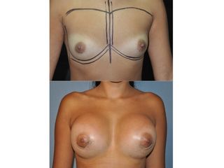 Antes y después Mamoplastia de aumento