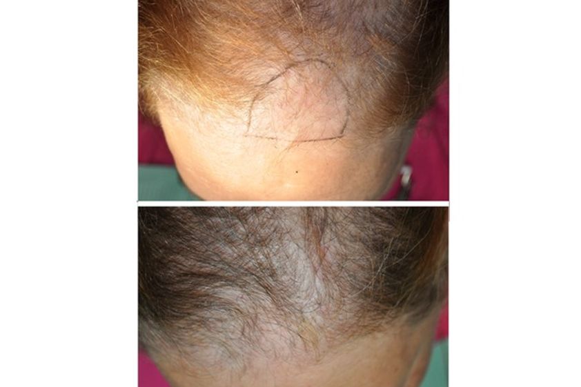 Alopecia antes y después - 500647