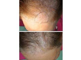 Antes y después Alopecia femenina (tratamiento sin cirugía capilar)