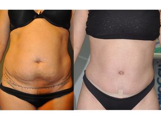 Antes y después Dermolipéctomia abdominoplastia