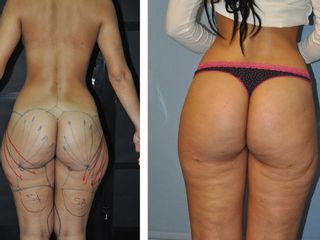 Antes y después Elevación glúteos + lipo cartucheras